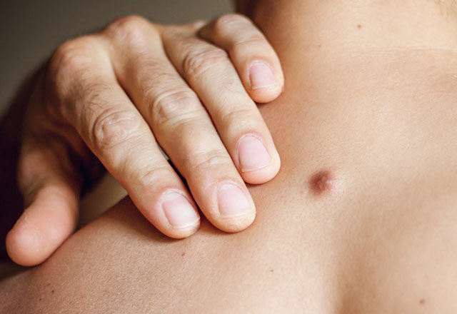 Kulak ve boyundaki topaklar bazı kistlerden kaynaklanıyor olabilir Bu kistler cildimizi ve saçımızı yağ ile kaplayan yağ bezelerini de oluşturur. Doktorlar genellikle görsel muayene sırasında kistleri teşhis eder, ancak bazı durumlarda ek testlere ihtiyaç duyulabilir. Boyun ve kulakta oluşan topaklar göz ardı edilmemelidir. Topaklarınızın tedavi gerektirip gerektirmediğini doktorunuza danışıp öğrenmelisiniz.
